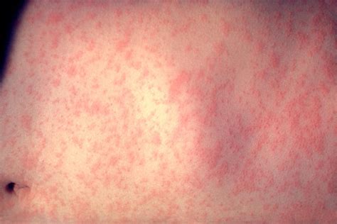 The Maculopapular Rash Causes Symptoms And Treatment