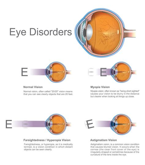 Eye Surgery Associates Eye Care Eye Health Broward County