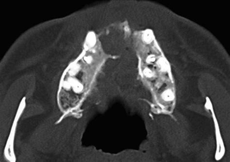 Interdisciplinary Treatment Of An Adult With Complete Bilateral Cleft Lip And Palate American