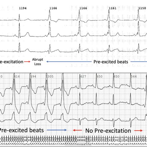 A Holter Monitor Tracing Demonstrating Intermittent Pre Excitation