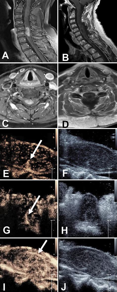 Preoperative A And Postoperative B Sagittal T1 Postcontrast