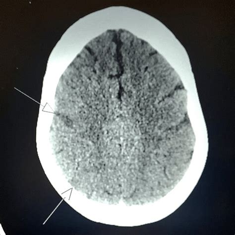 CT Brain Showing Acute Infarct In The Right Frontal And Right Parietal