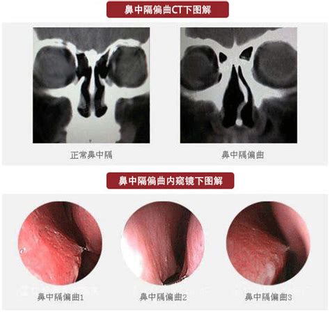 霞浦康明医院鼻中隔偏曲要治疗吗有哪些危害 腾讯新闻