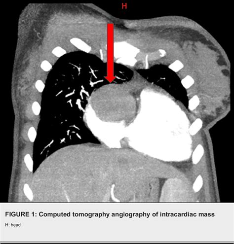 Figure From Cardiac Hemangioma A Rare Tumor Presenting As Postpartum