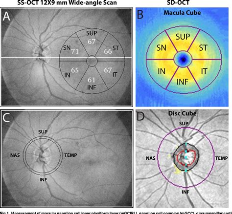 Figure 1 From Diagnostic Ability Of Macular Ganglion Cell Inner