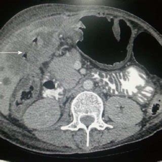 Axial Contrast Enhanced Computed Tomography Abdominal Section Shows