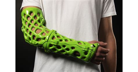 New 3d Printed Orthopedic Casts