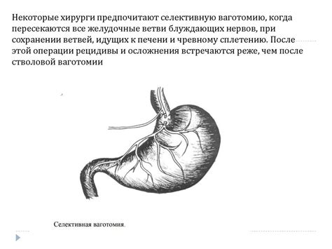 Хирургическое лечение осложненных язв желудка - презентация онлайн