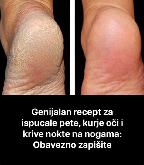 Genijalan Recept Za Grube Ruke Ispucale Pete Kurje O I I Krive Nokte