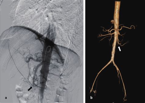 A Abdominal Aortography Occlusion In The Distal Third Of The