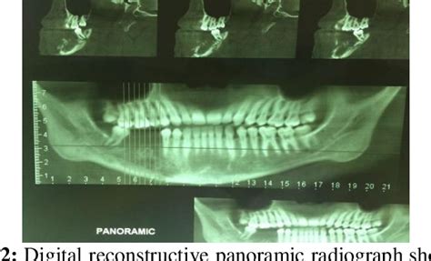 Tubercular Osteomyelitis Of The Jaw 2 Case Report Semantic Scholar