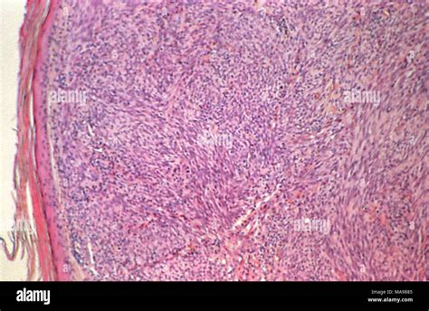 Sarcoma Della Kaposi Immagini E Fotografie Stock Ad Alta Risoluzione