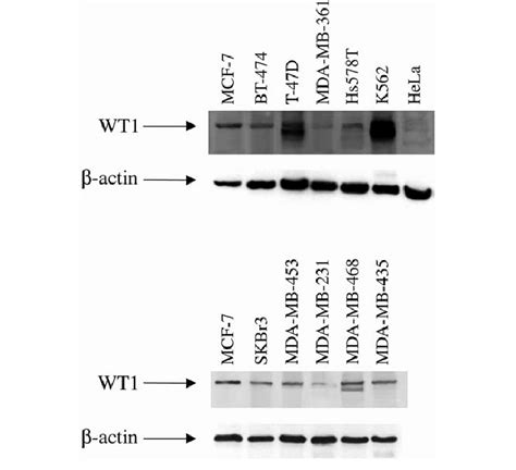 Expression Of Wt1 Protein In Human Breast Cancer Cell Lines Wt1