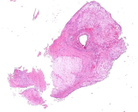 Pathology Outlines Nephrogenic Metaplasia