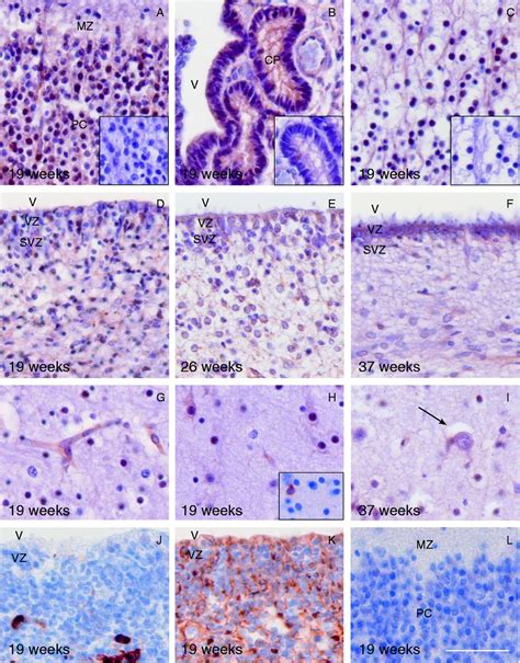 Mct8 Expression In Human Fetal Cerebral Cortex Is Reduced In Severe