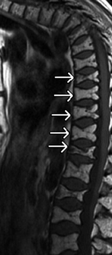 And Malignant Vertebral Fractures Radiology Key