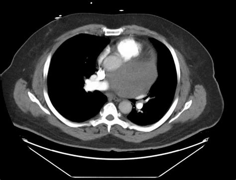 Mediastinal Metastatic Melanoma An Unusual Case Presentation Of Recurrent Melanoma Bmj Case