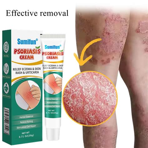 Sumifun Original Psoriasis Eczema Cream Antibacterial Anti Itching