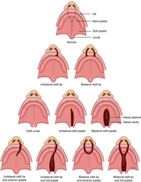 Cleft Lip Diagram