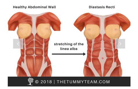 Diastasis Recti What You Need To Know Active Moms Club