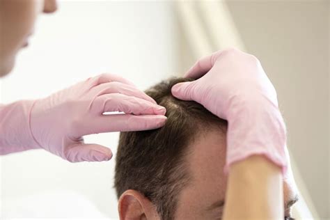 Foliculitis decalvante síntomas causas y tratamiento Tua Saúde