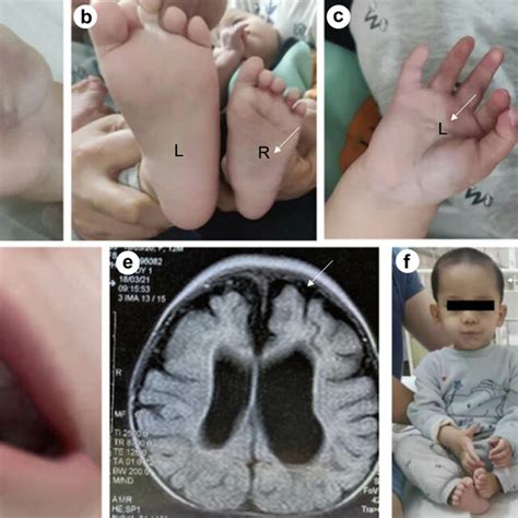 Physical features and MRI of the brain of the girl. (a) Simian crease ...