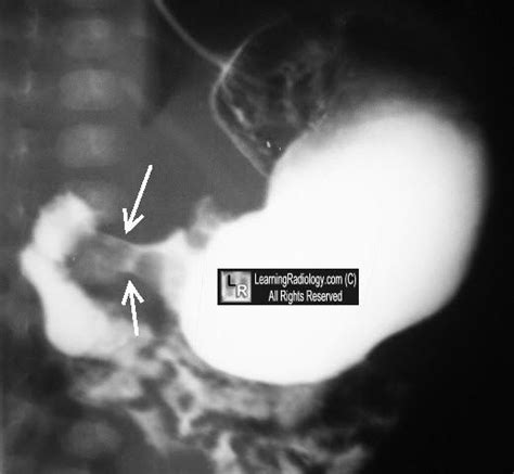 Double Track Sign Pyloric Stenosis