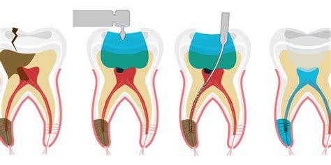 Tractament d Endodòncia Dentista Pineda de Mar Clinica Dental Blanc