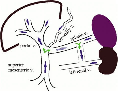 Hepatofugal Flow In The Portal Venous System Pathophysiology Imaging