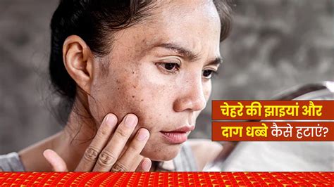 चेहरे से झाइयां और दाग धब्बे कैसे मिटाएं जानें 5 उपाय How To Remove