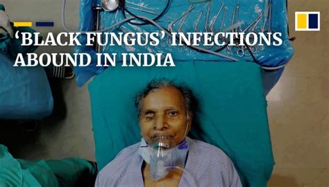 Nearly 41,000 cases of ‘black fungus’ infection confirmed in India ...