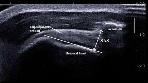 56 Supraspinatus Tendinopathy Assoications Of Subacromial Space And