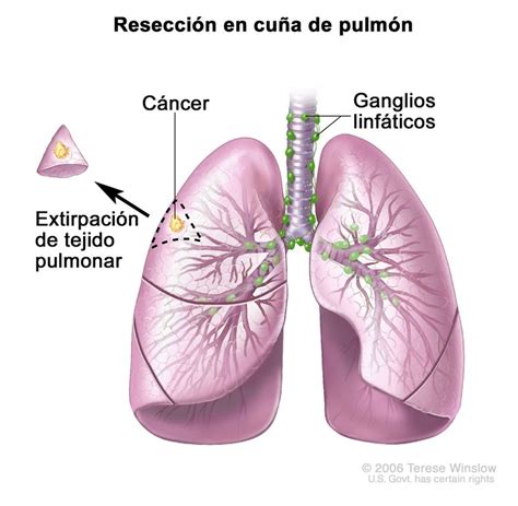 Tratamiento Del C Ncer De Pulm N De C Lulas No Peque As Nci