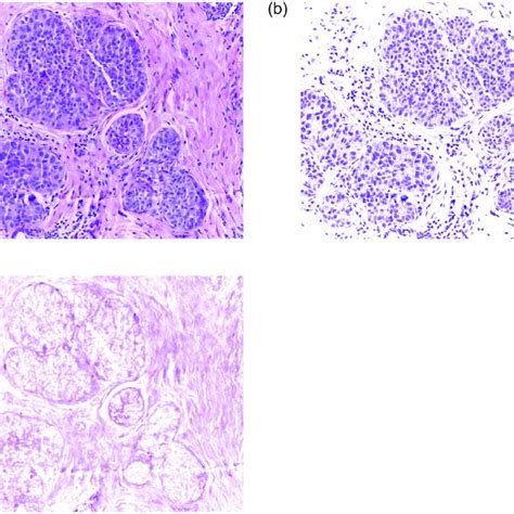 The Framework Of Breast Cancer Histopathological Images Recognition