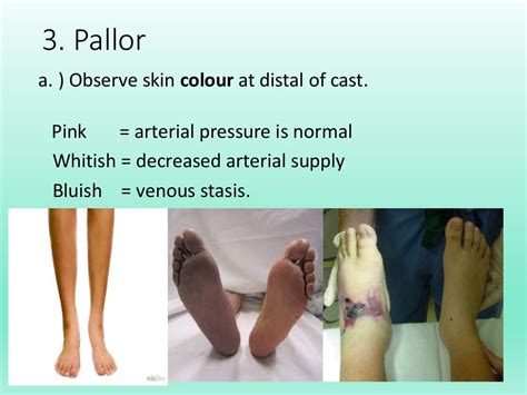 Neurovascular Assessment