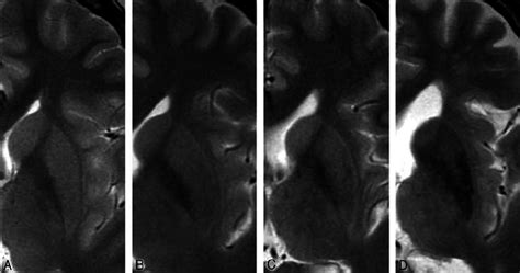 Classification Of Hpr On Axial T2 Weighted Fse Images A Absent 15