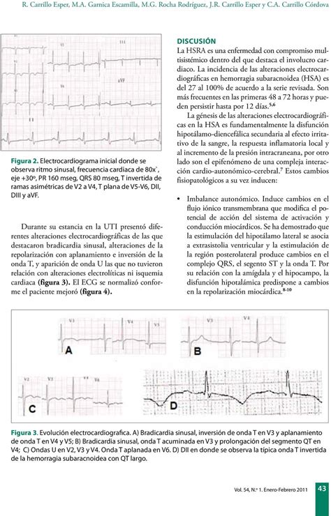 Alteraciones Electrocardiogr Ficas En Hemorragia Subaracnoidea Pdf