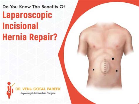 Do You Know The Benefits Of Laparoscopic Incisional Hernia Repair