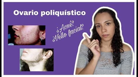 SÍNDROME DE OVARIO POLIQUÍSTICO VELLO FACIAL EN MUJERES YouTube