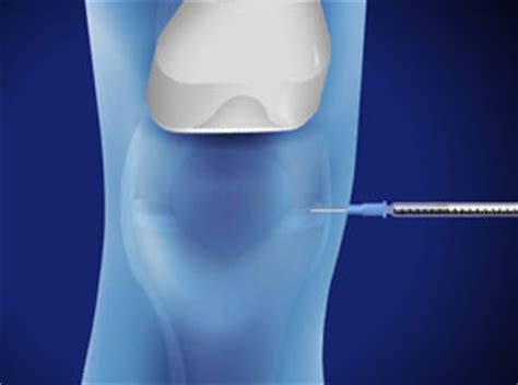 Ultrasound-Guided Injection for Knee Pain - Nevada Pain Care