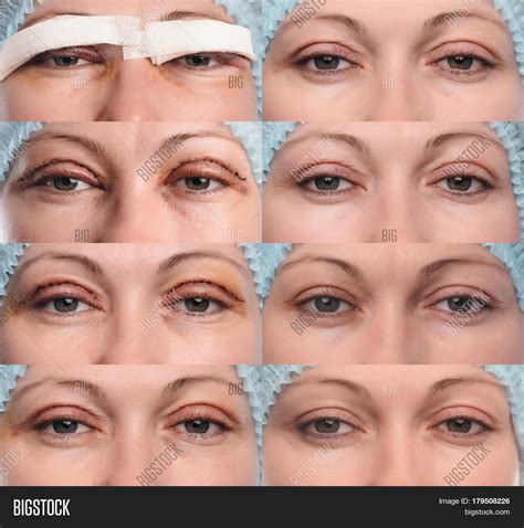 Top Pictures Lower Blepharoplasty Recovery Photos Day By Day Updated