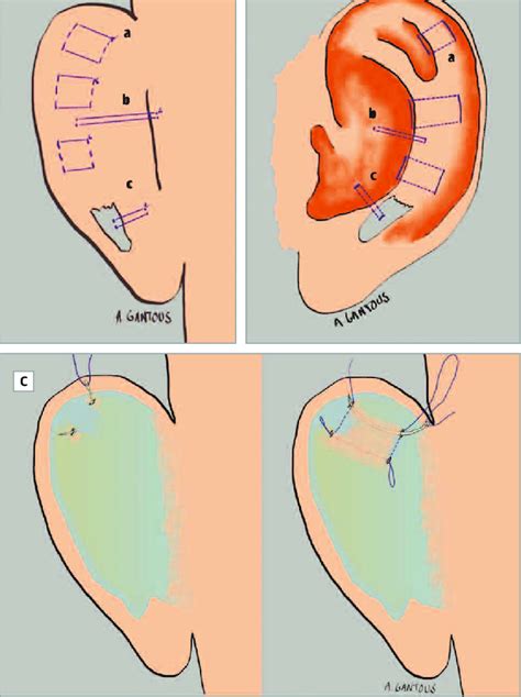 Suture Placement In Incisionless Otoplasty And Transcutaneous Placement