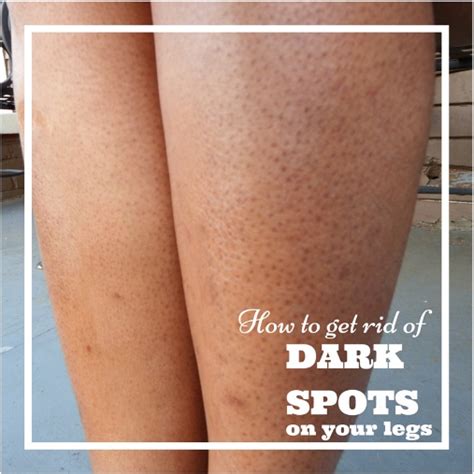 How To Get Rid Of Dark Pores On The Legs Top Beauty Enhancer