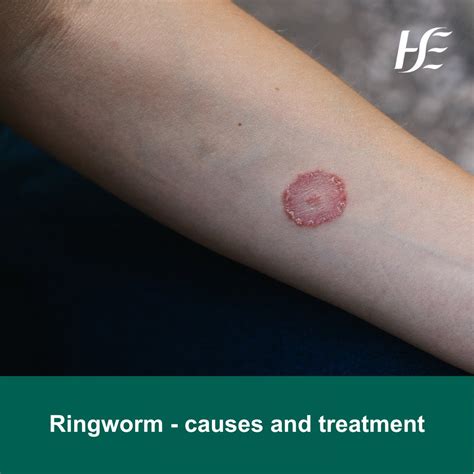 Ringworm Rash On Arm