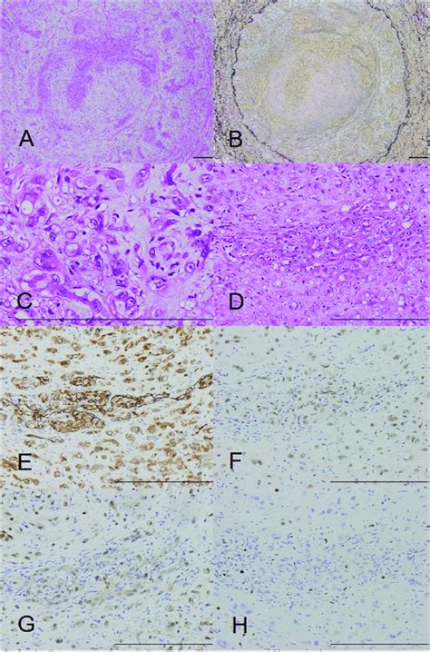 Histological And Immunohistochemical Findings Of Case The Tumor