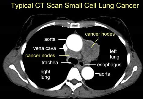 Small Cell Lung Cancer Pictures