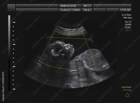 Ultrasound of baby in mother's womb. Stock Photo | Adobe Stock