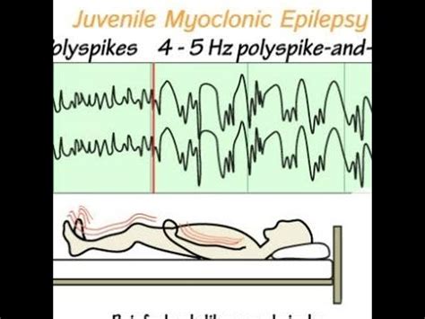 Epilepsia Miocl Nica Juvenil O S Ndrome De Janz Jme Youtube