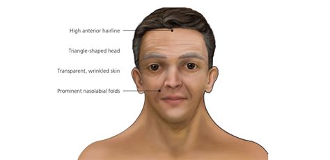 NOONAN SYNDROME TREATMENT