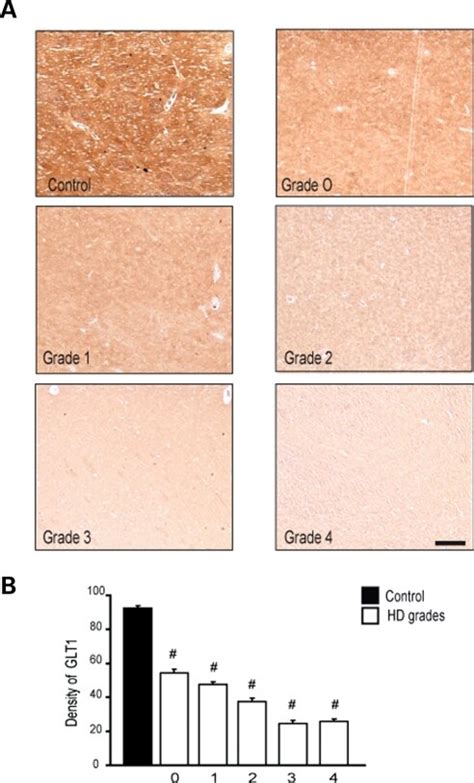 Immunohistochemical Expression Of GLT 1 In The Caudate Nucleus From